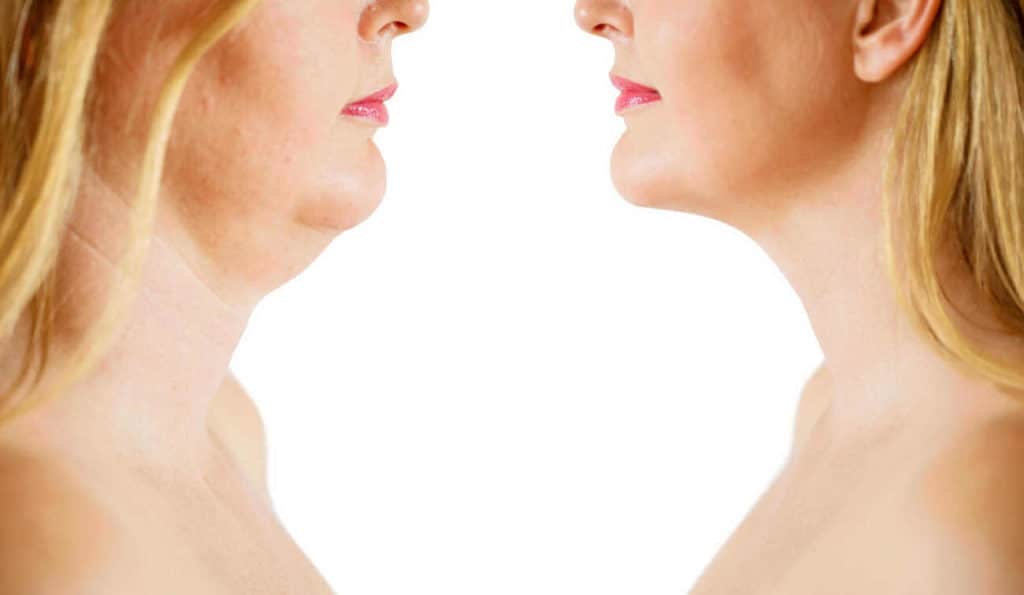Double Chin treatment Batley before and after results