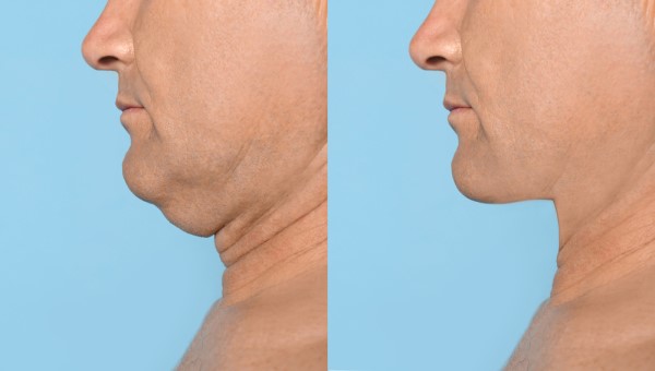 Which Non-Surgical Treatments Work Best for Jowls and Loose Skin Batley?
