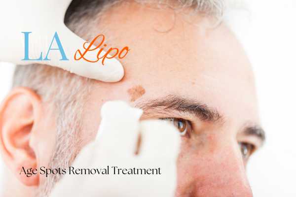 What Are the Most Effective Treatments for Age Spots Batley?