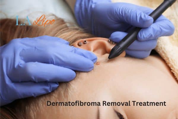 Dermatofibroma Removal Treatment Batley