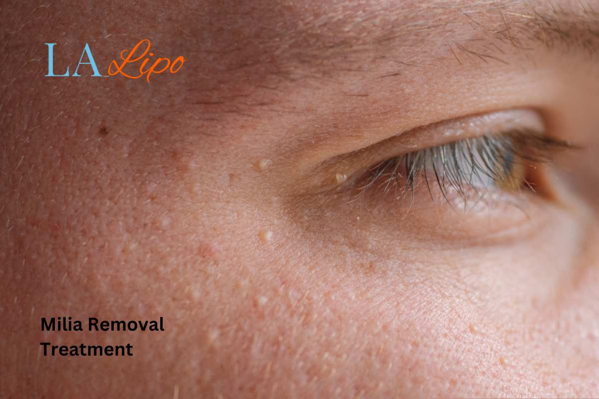 Cryopen Milia Removal: Is It the Easiest and Safest Option Batley?
