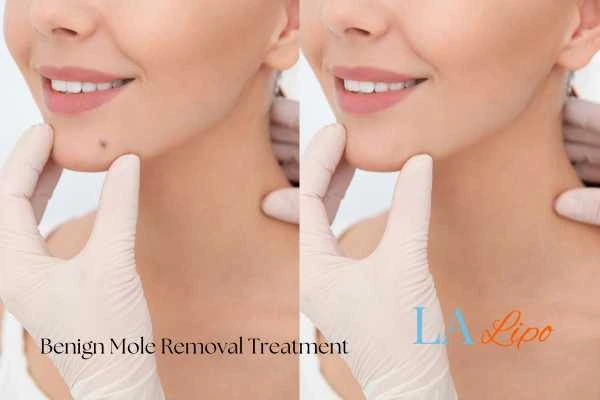 woman's before and after mole removal Batley results