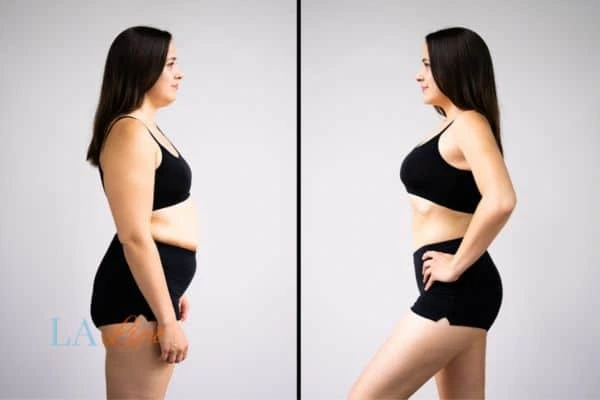 image of woman before and after results of LA-EMS Body Sculpting Batley to help treat Diastasis recti