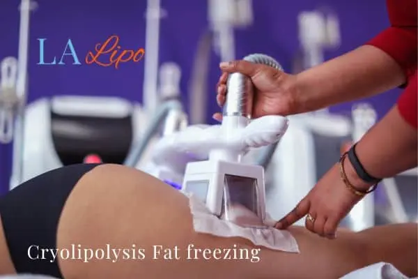 women getting fat freezing Batley