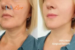 hi-fu for wrinkles Batley before and after results