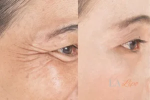 Before and after results of woman - HI-fu wrinkles reduction treatment Batley
