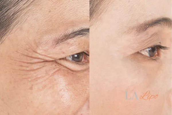 Before and after results of woman - HI-fu wrinkles reduction treatment Batley