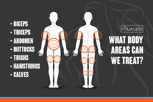 Graphic to show areas you can have LA-EMS Body Sculpting Batley treatment.