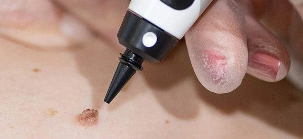 skin tag removal using cryopen Batley