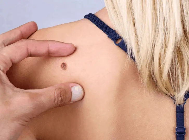 woman having mole removal Batley consultation before treatment.