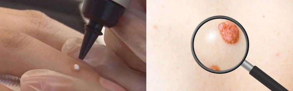 CryoPen practitioner Batley assessing a benign mole before treatment