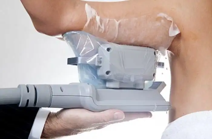 Picture of fat freezing Batley on the upper arms.