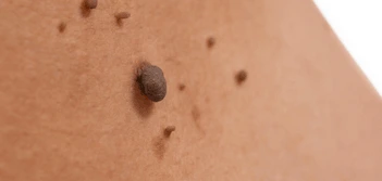 image of a skin tag Batley