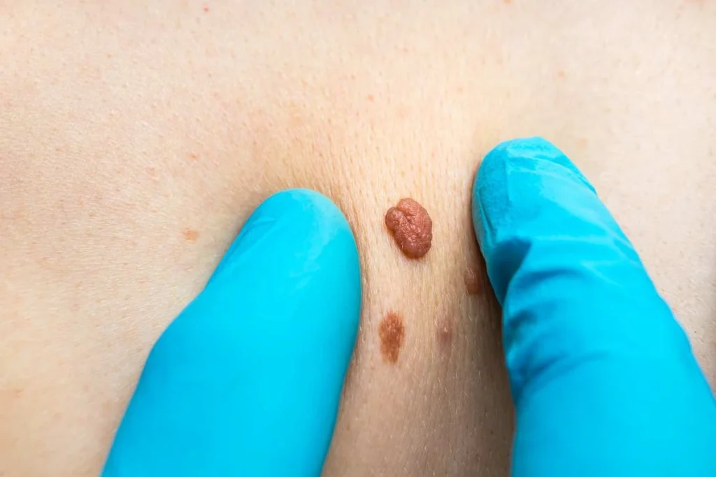 Consultant examining a skin tag Batley