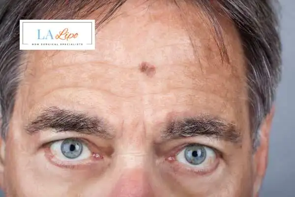 Solar Lentigo Removal Batley image of man with mark on his forehead