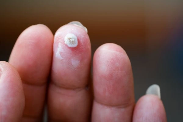 wart on person finger - cryotherapy to treat from LA LIPO Batley