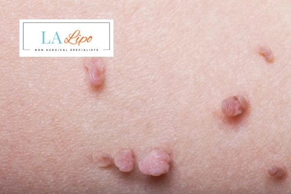 Does cryopen skin tag removal Batley hurt? Find out now call our team today!
