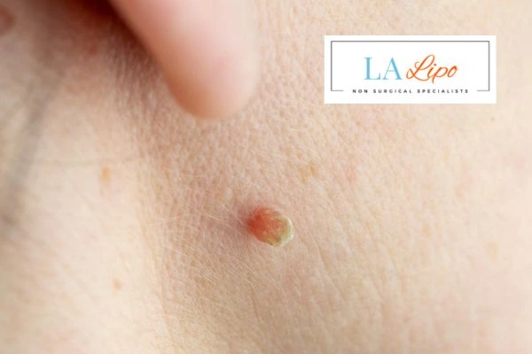 Book skin tag removal Batley today speak to our team now!