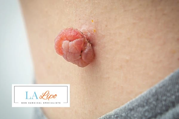 Interested in skin tag removal Batley? Concerned about the pain? Find out more today!
