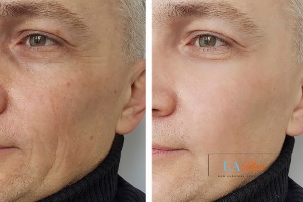 See the amazing results of Morpheus8 Treatment Batley!