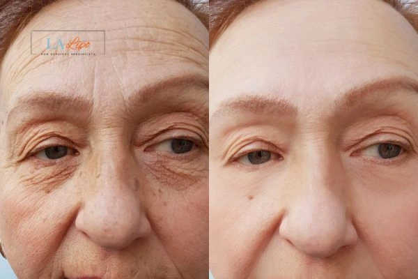 The powerful benefits of Morpheus8 Treatment Batley - Call Our team today!