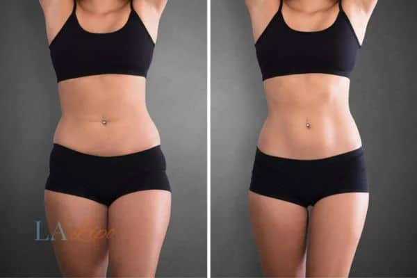 before and after results of non-surgical treatment to help a woman's body image and mental health Batley