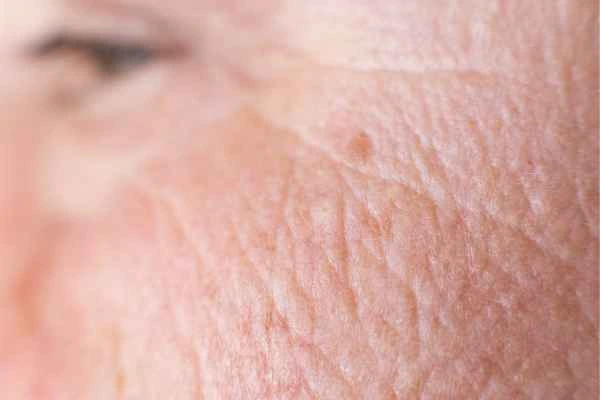 close up picture of a woman's face showing an age spot Batley