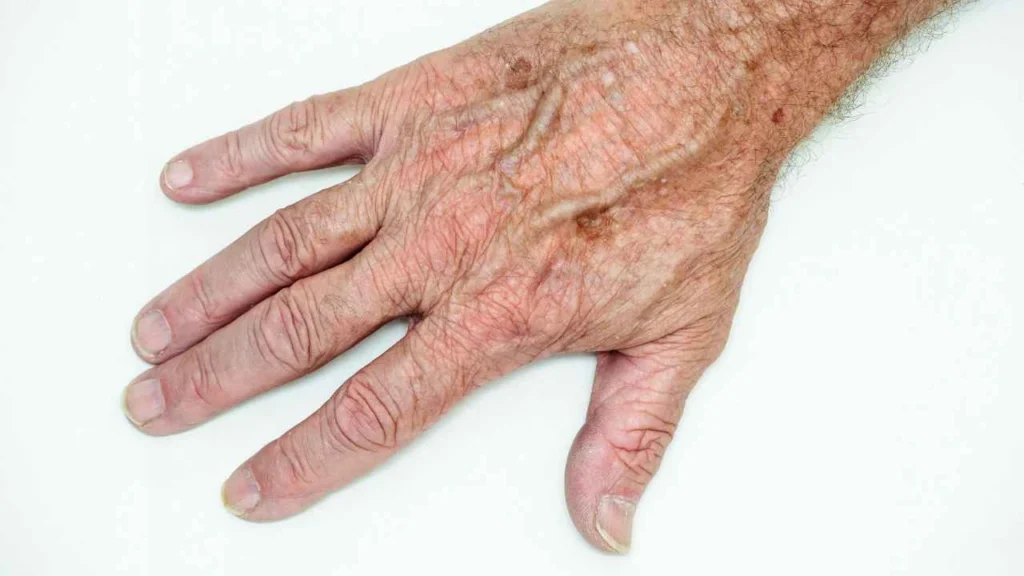Male hand showing age spot Batley