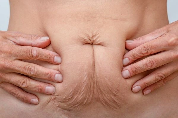 Image of a woman's stomach with loose skin - example of skin tightening Batley options