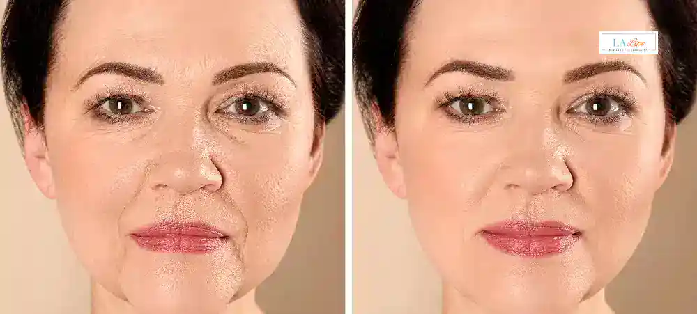 How Long Does It Take to See Results and How Long Do They Last Batley?