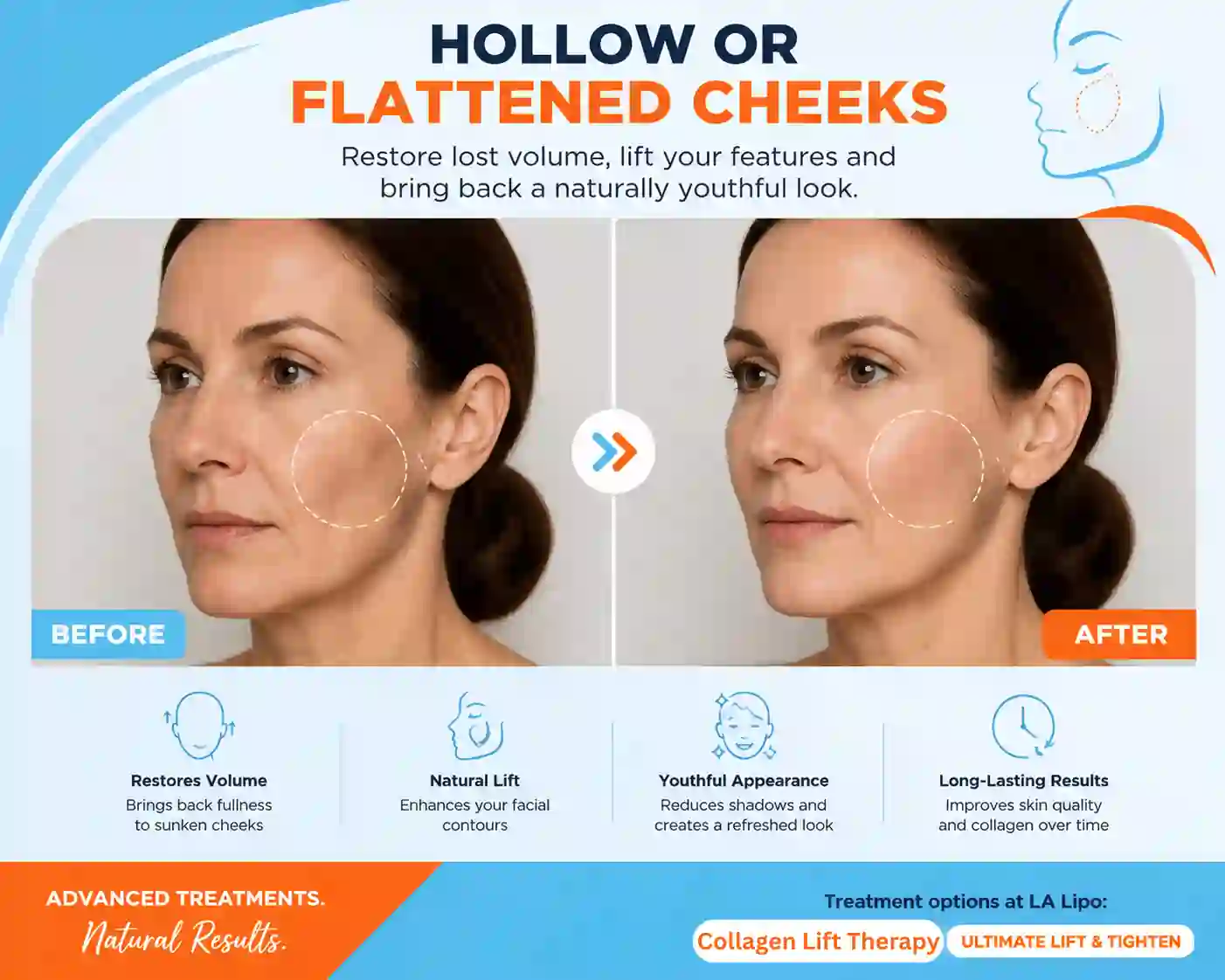 Sign #4: Hollow or Flattened Cheeks Batley